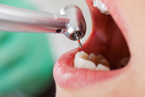 Best Emergency Wisdom Teeth Removal in Morenci, MI